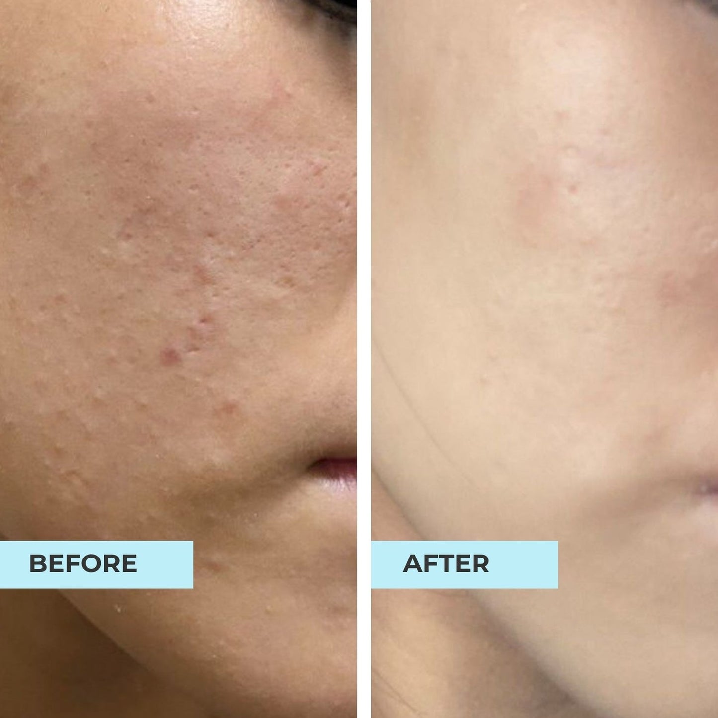SA smoothing cream for dry rough , bumpy skin